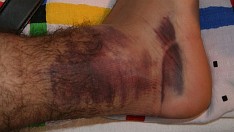 Noga Sikora po jego jedynym występie w Lawie